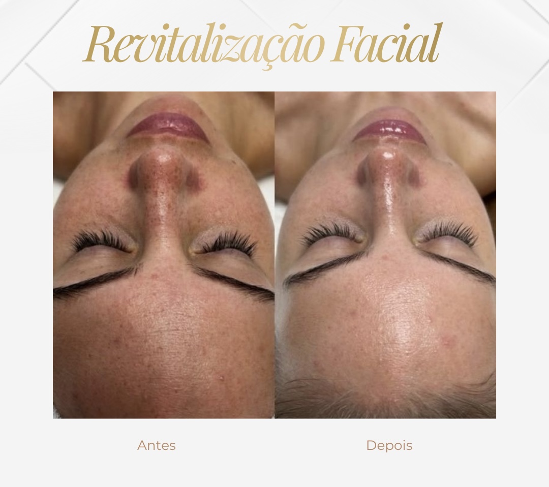 Harmonização Facial — Black Shine