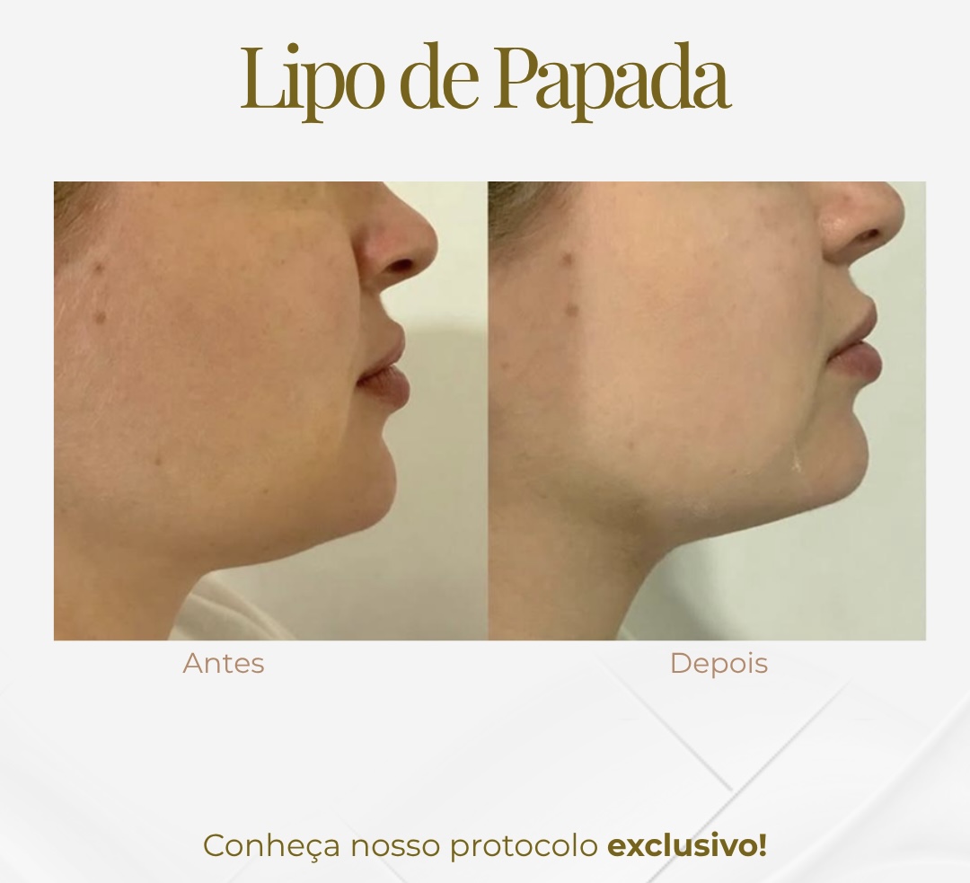 Lipo de Papada — Black Shine