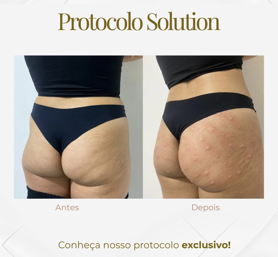 Tratamento de Celulite — Black Shine
