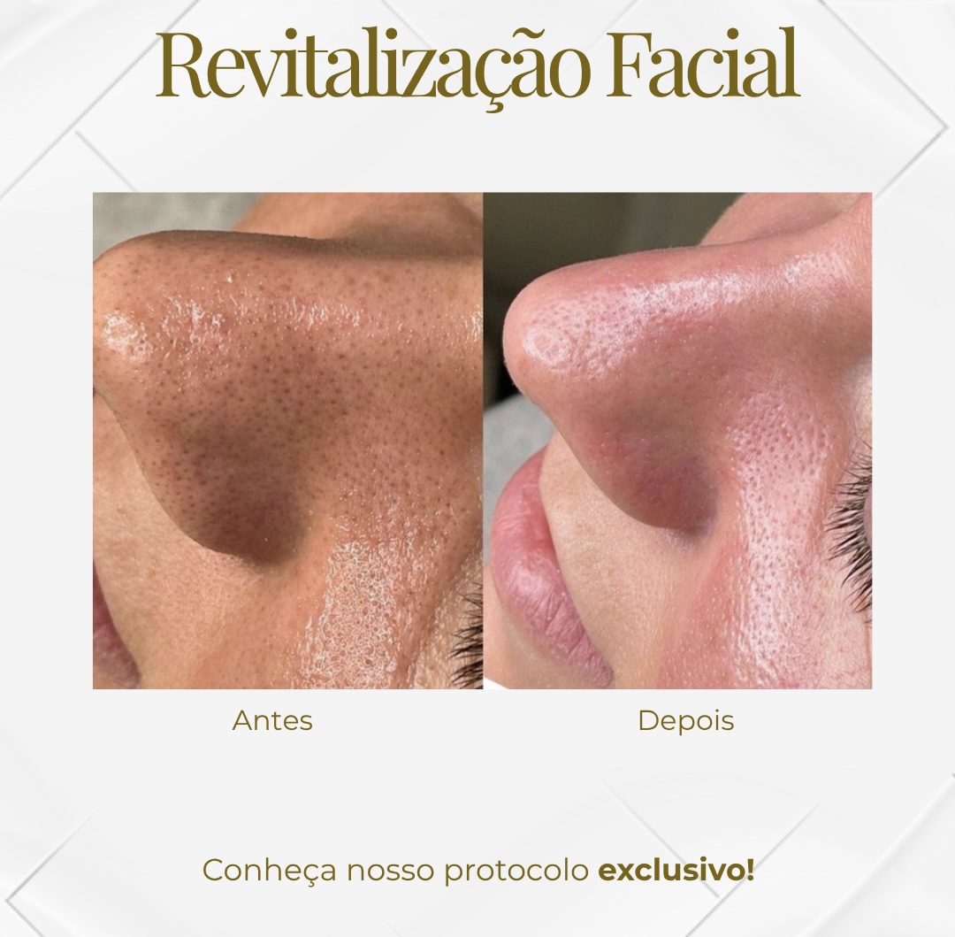 Harmonização Facial — Black Shine
