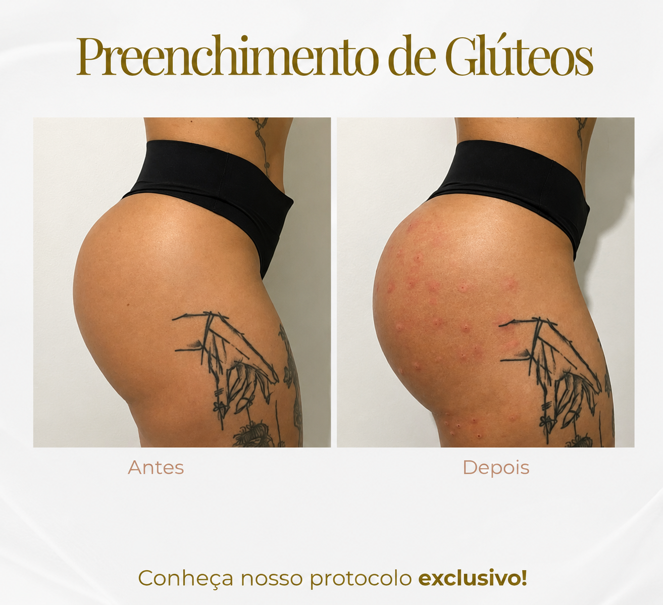 Harmonização Glútea — Black Shine